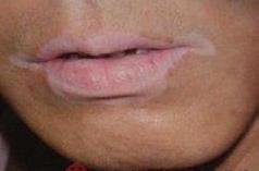 成人白癜風的初期癥狀