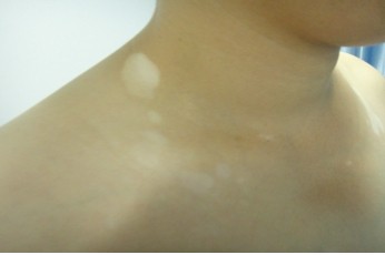 年輕人患上白癜風了癥狀有什么不同嗎