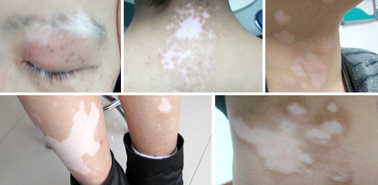 白癜風(fēng)早期癥狀需要了解哪些