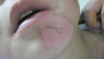 發(fā)病的初期白癜風(fēng)白斑都有哪些癥狀