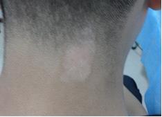 早期的白癜風(fēng)一般看不出來嗎