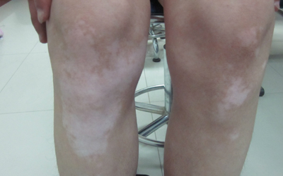 腿上出白斑圖片