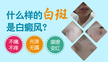 白癜風前期都有哪些癥狀表現