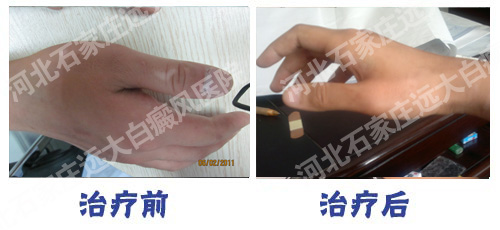 雙手都患上了白癜風 這如何治療呢?