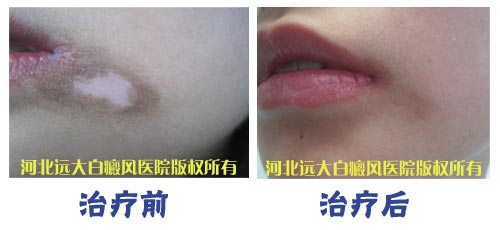 <a href=http://www.xvxgx.cn/ target=_blank class=infotextkey>石家莊白癜風醫院</a>臉上患有白癜風應該如何治療好