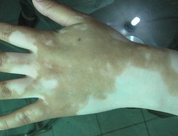 <a href=http://www.xvxgx.cn/ target=_blank class=infotextkey>石家莊白癜風醫院</a>治療白癜風需要注意什么?