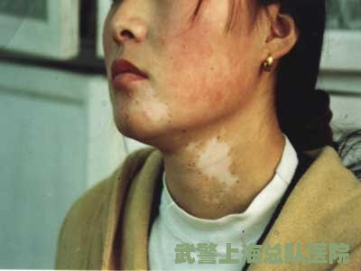 石家莊元氏好的白癜風(fēng)治療方法是什么?白癜風(fēng)終于治好了