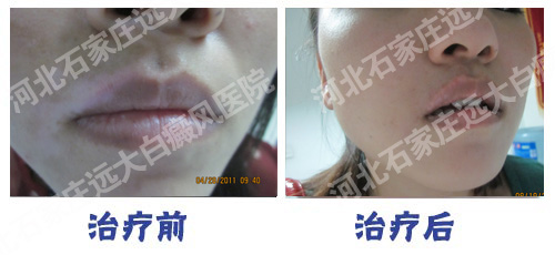 白癜風真的能治好嗎?