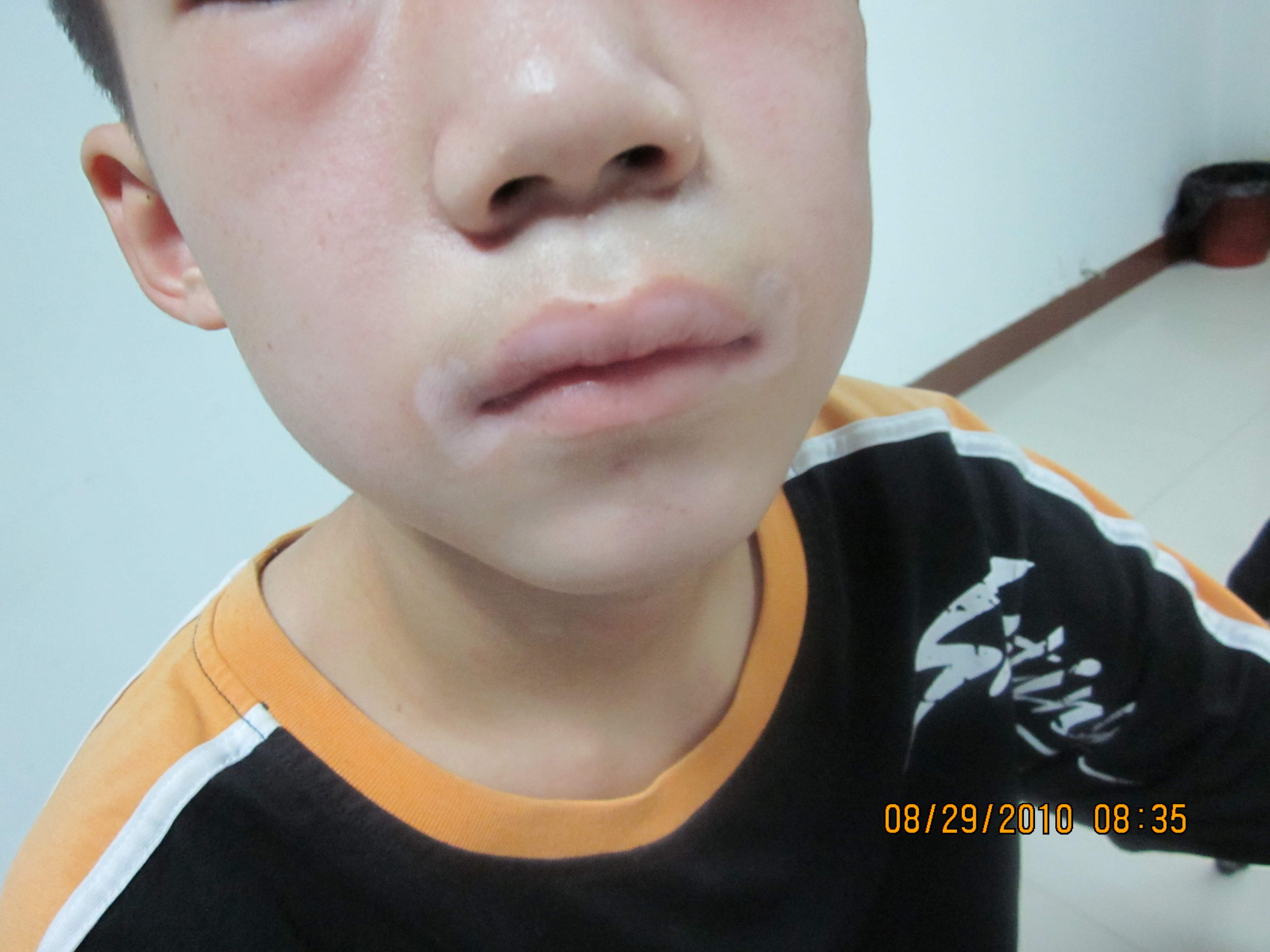 小孩用308激光治白癜風(fēng)疼嗎