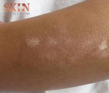 白癜風(fēng)患者如何進(jìn)行準(zhǔn)確的自我診斷?