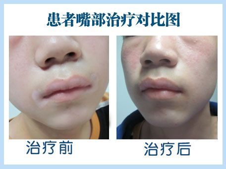 白癜風治療效果好的方法有哪些?