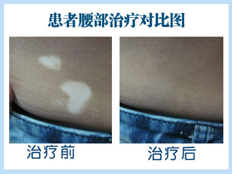 白癜風(fēng)治療效果好的療法