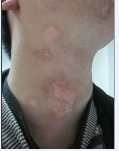 白癜風患者出現皮膚過敏要怎么辦?