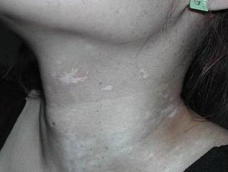 怎么治療局限性白癜風(fēng)才不會(huì)擴(kuò)散