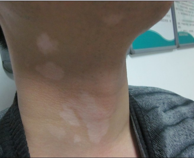 節(jié)段型白癜風(fēng)早期癥狀有什么?