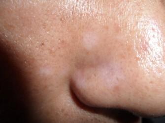 治療早期白癜風(fēng)都有哪些好的方法