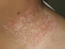 發展期白癜風怎么能控制病情不再發展?