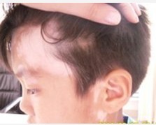 兒童白癜風(fēng)治療較好的方法是哪種?