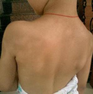 兒童白癜風患者在選擇治療方法時要注意哪些