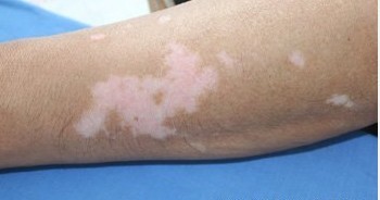 如何控制早期白斑不擴散？