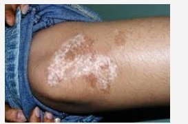 創(chuàng)傷性白癜風(fēng)白斑該怎么治療?