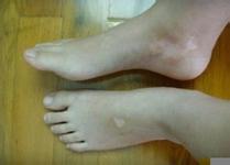 白癜風初期治療什么方法好? 