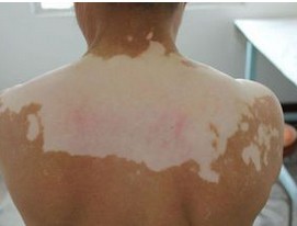 泛發(fā)型白癜風該怎么治療?