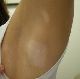 輕微的白癜風(fēng)是不是能治療?