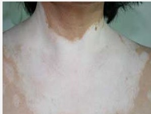 全身泛發白癜風是否可以治好?