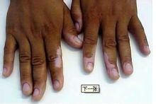 創傷型白癜風如何進行治療