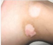 青少年如何治療繼發(fā)性白癜風(fēng)疾病