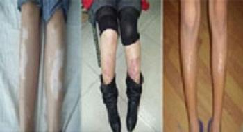 腿部白癜風(fēng).jpg