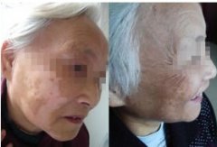 老年人得了白癜風能治好嗎