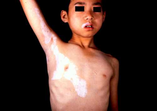 兒童白癜風(fēng).jpg