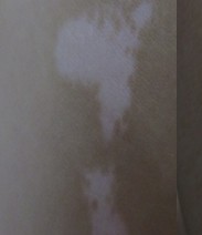 如何 治好白癜風(fēng)