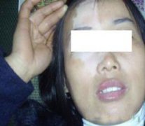 治療臉上的白癜風(fēng)什么方法比較好？