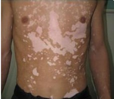 患了白癜風如何系統治療