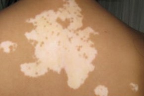 白癜風怎樣治療才能達到較好的效果