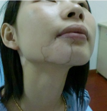 臉上有白斑怎么治療好