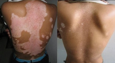 河北好的白癜風(fēng)醫(yī)院是哪呀