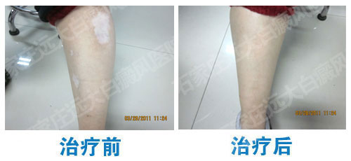 腿部白癜風(fēng)該怎么治療?