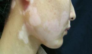 臉部白癜風怎么治療好