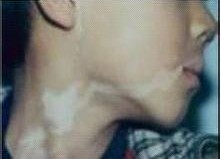 小孩子脖子上長(zhǎng)白癜風(fēng)要怎么治療