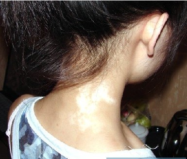 8歲的孩子剛患白癜風初期怎么治