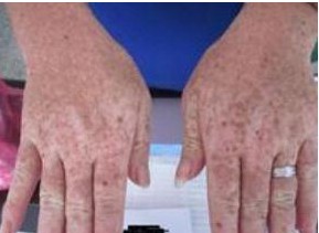 手部白癜風的好療法