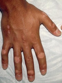 手指上白癜風能有效治療嗎