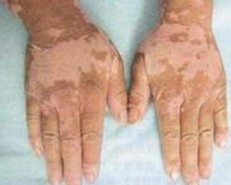  β-胡蘿卜素對(duì)白癜風(fēng)的治療有益嗎？