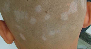 白癜風(fēng)的克星——308nm準(zhǔn)分子激光