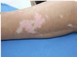 白癜風(fēng)的輔助治療方法都有哪些