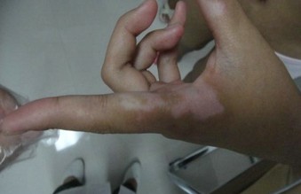 白癜風怎么一直治不好